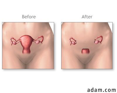 Before and after hysterectomy