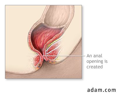 Imperforate anus repair