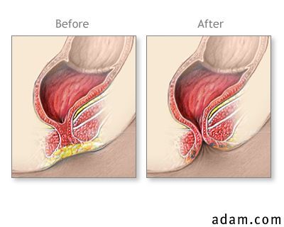 Before and after imperforate anus repair