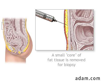Fat tissue biopsy