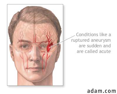 Ruptured intracranial aneurysm