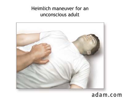 Adult Heimlich maneuver (unconcious)