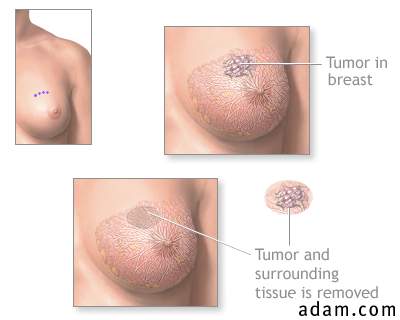 Excision of breast lump