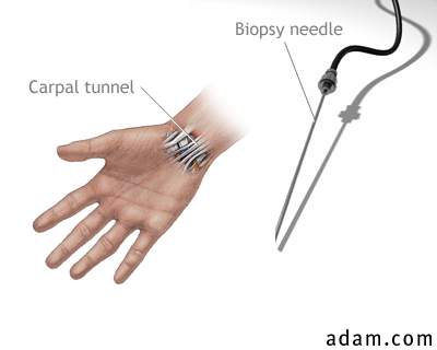 Carpal biopsy