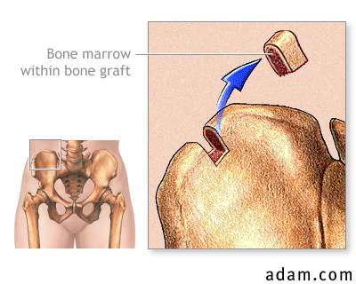 Bone marrow from hip