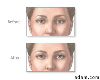 Before and after eyelid repair