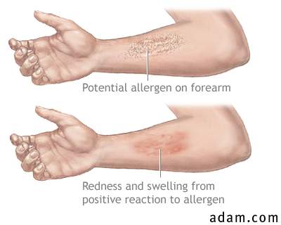 Positive reaction to allergen