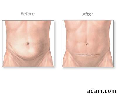 Before and after abdominal surgery