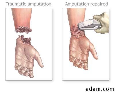 Amputation repair
