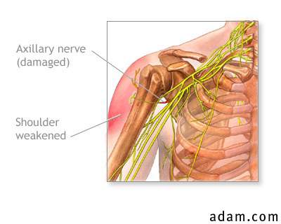 Damaged axillary nerve
