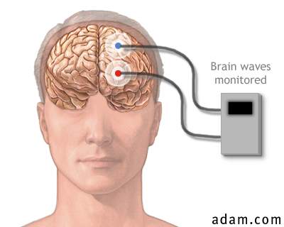 Brain wave monitor