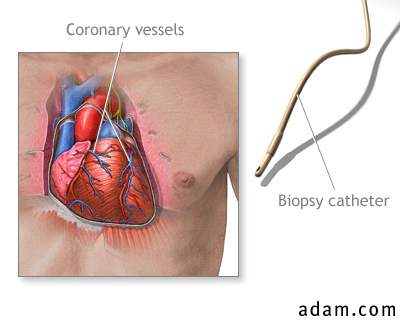 Coronary artery angiogram