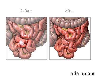 Before and after diverticulum removal