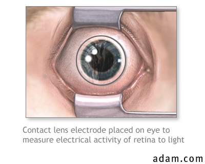 Contact lens electrode on eye