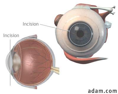Corneal incision for cataract surgery
