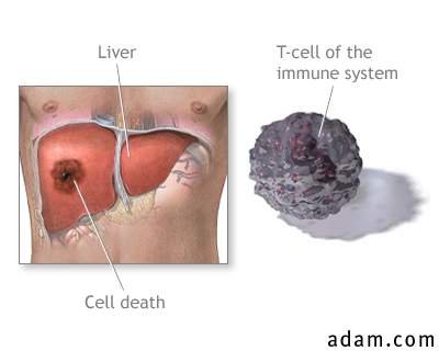 Liver cell death