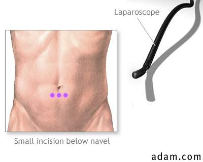 Incision for abdominal laparoscopy