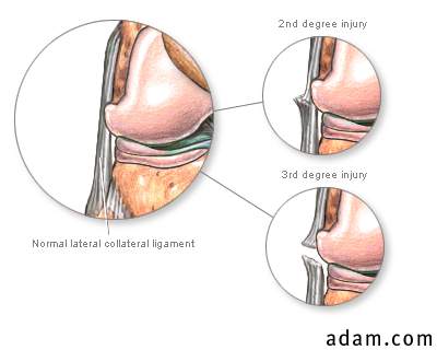 Lateral collateral ligament injury