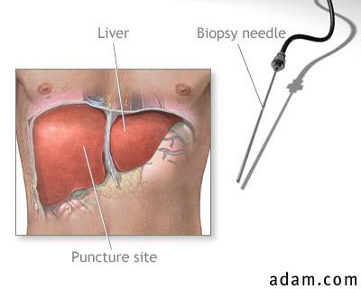 Liver biopsy