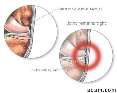 Medial collateral ligament pain