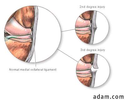 Medial collateral ligament injury