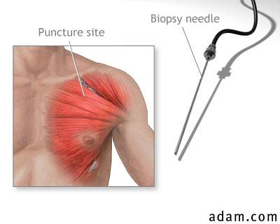 Muscle biopsy