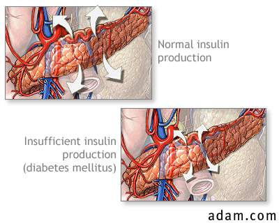 Insulin production and diabetes