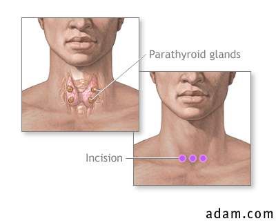 Parathyroid biopsy