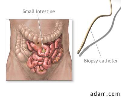Small intestine biopsy