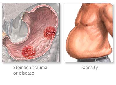 Stomach disease or trauma