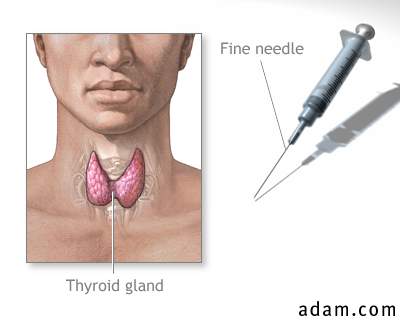 Thyroid gland biopsy