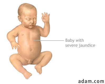 Infant jaundice