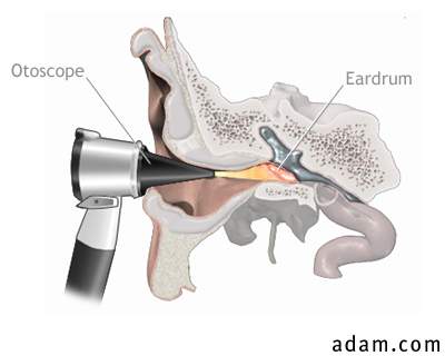 Ear infection with fluid