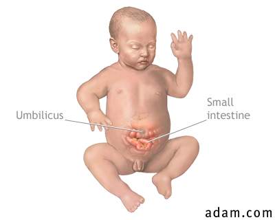 Infant umbilical hernia