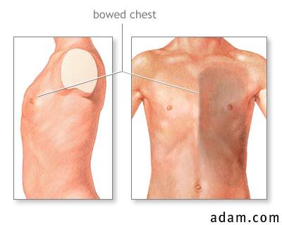 Bowed chest