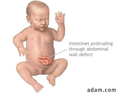Infant abdominal hernia