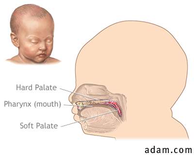 Infant hard and soft palates