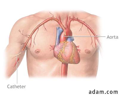 Cardiac arteriogram