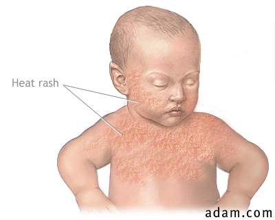 Infant heat rash