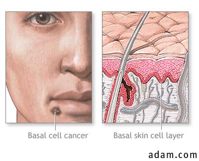 Basal cell cancer