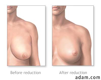 Before and after breast revision