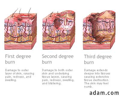 Burn types