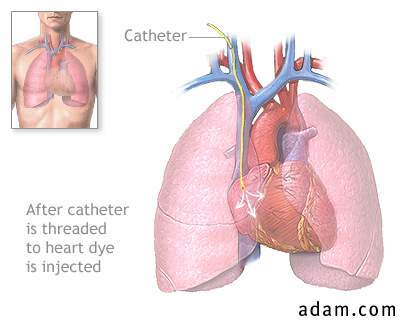 Cardiac catheterization