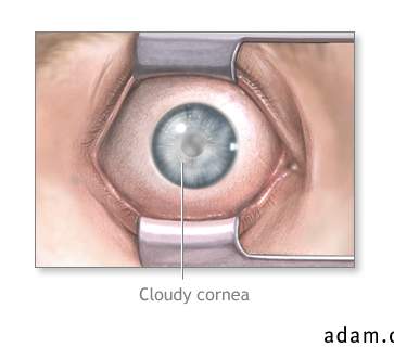 Cloudy cornea