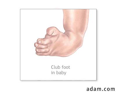 Infant club foot
