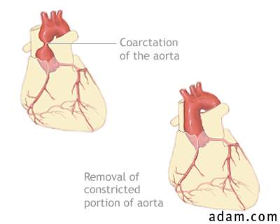 Coarctation of the aorta