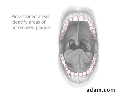 Dental plaque stain
