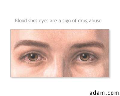 Signs of drug abuse