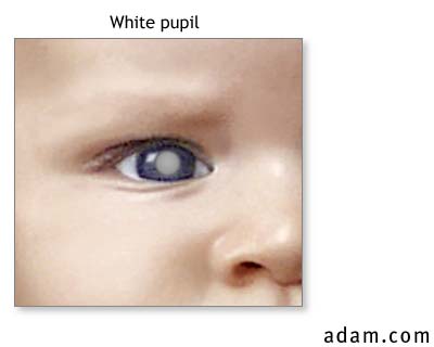 White pupil