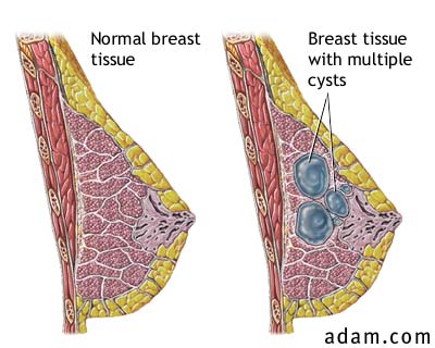 Fibricystic breast disease
